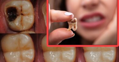 tooth teeth decay cavities