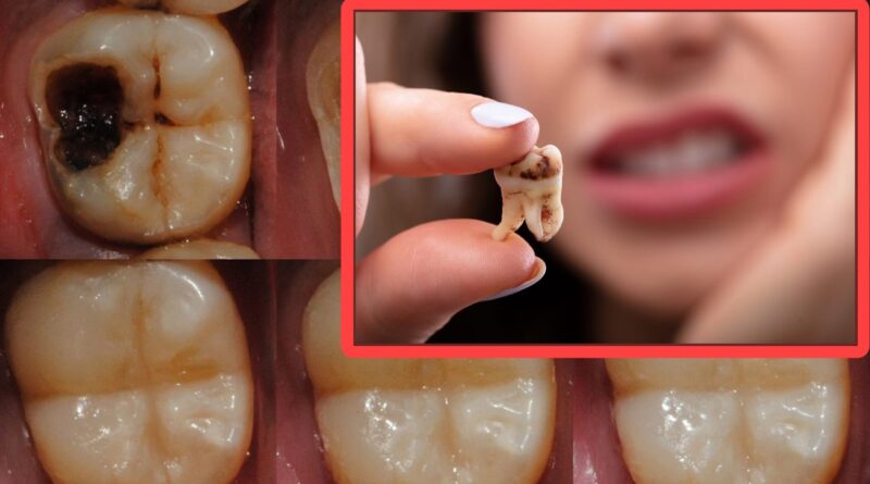 tooth teeth decay cavities