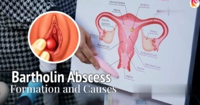 Bartholin abscess