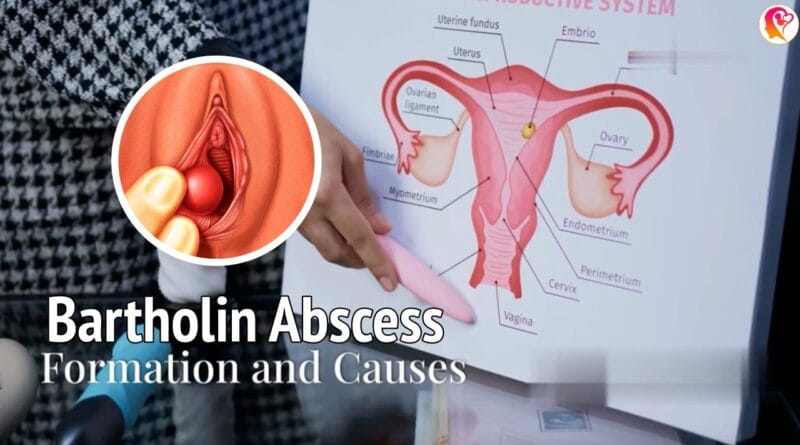Bartholin abscess