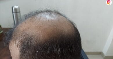 how to regrow hair naturally