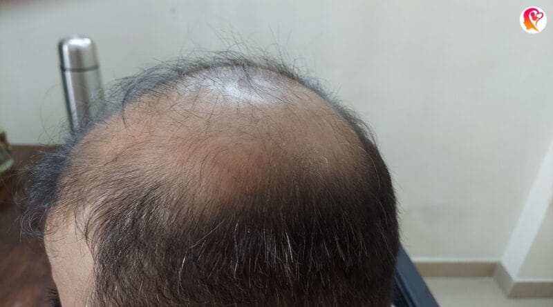 how to regrow hair naturally